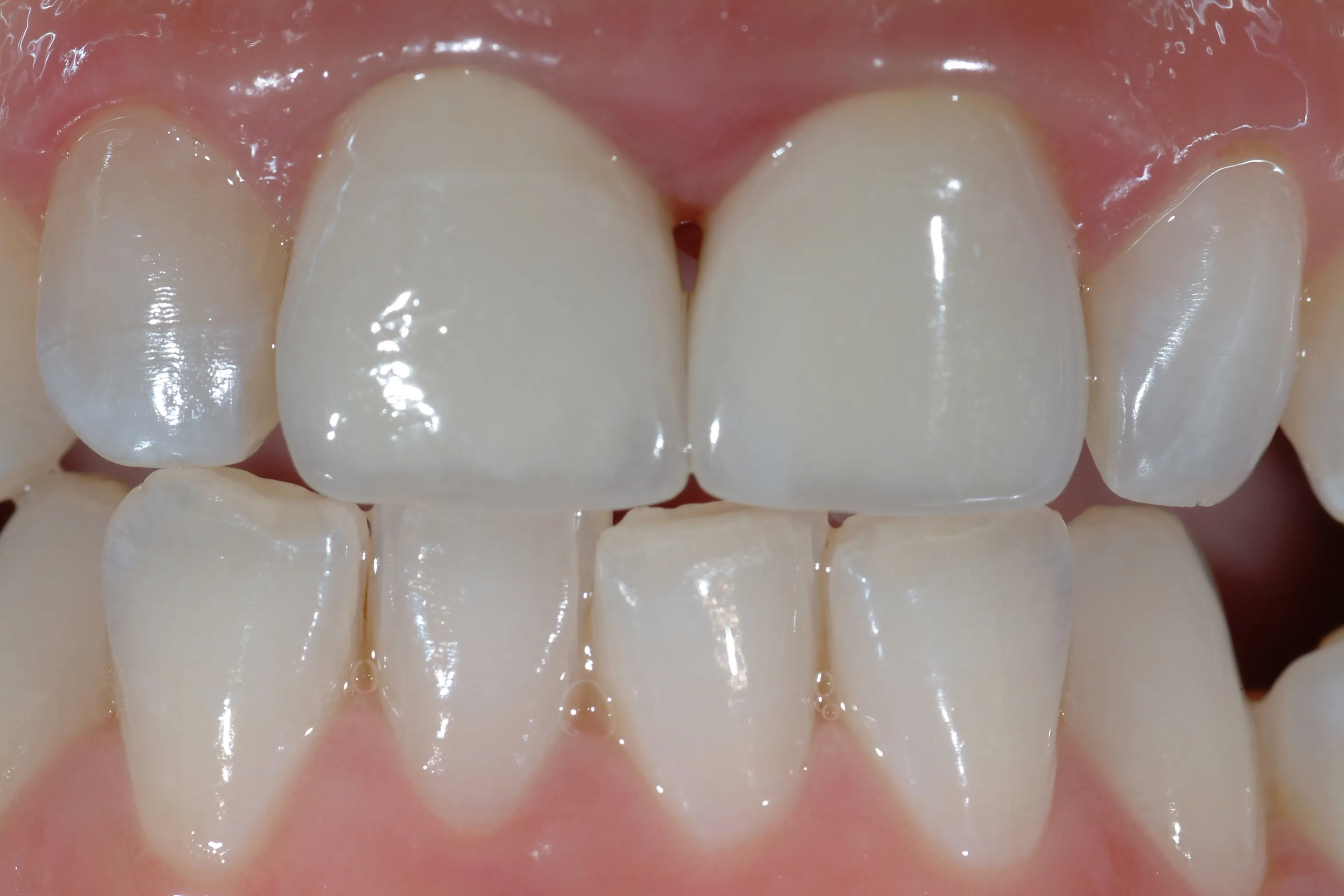 Prima del trattamento - Sostituzione di vecchi restauri incongrui